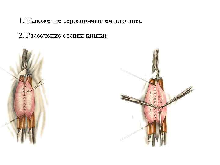 1. Наложение серозно-мышечного шва. 2. Рассечение стенки кишки 