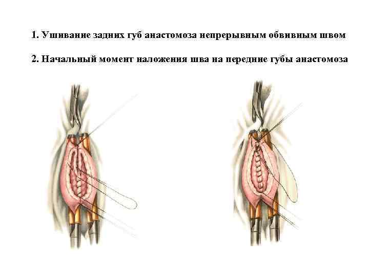 1. Ушивание задних губ анастомоза непрерывным обвивным швом 2. Начальный момент наложения шва на