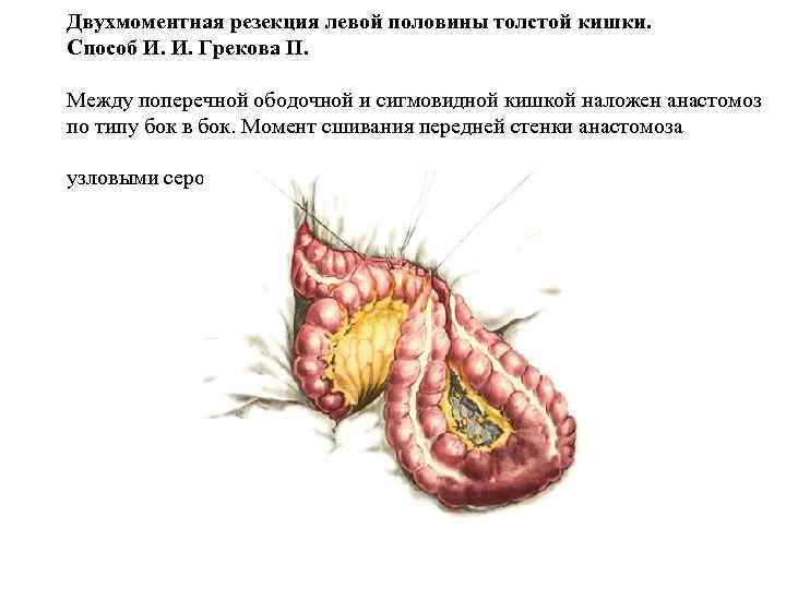 Двухмоментная резекция левой половины толстой кишки. Способ И. И. Грекова II. Между поперечной ободочной