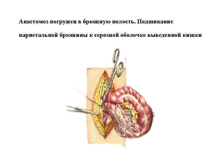 Анастомоз погружен в брюшную полость. Подшивание париетальной брюшины к серозной оболочке выведенной кишки 