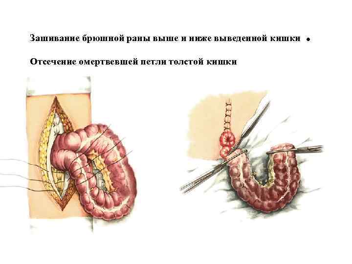 Зашивание брюшной раны выше и ниже выведенной кишки Отсечение омертвевшей петли толстой кишки .