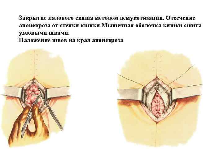 Закрытие калового свища методом демукотизации. Отсечение апоневроза от стенки кишки Мышечная оболочка кишки сшита