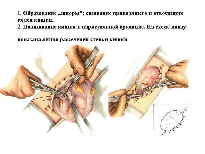 1. Образование „шпоры"; сшивание приводящего и отводящего колен кишки. 2. Подшивание кишки к париетальной