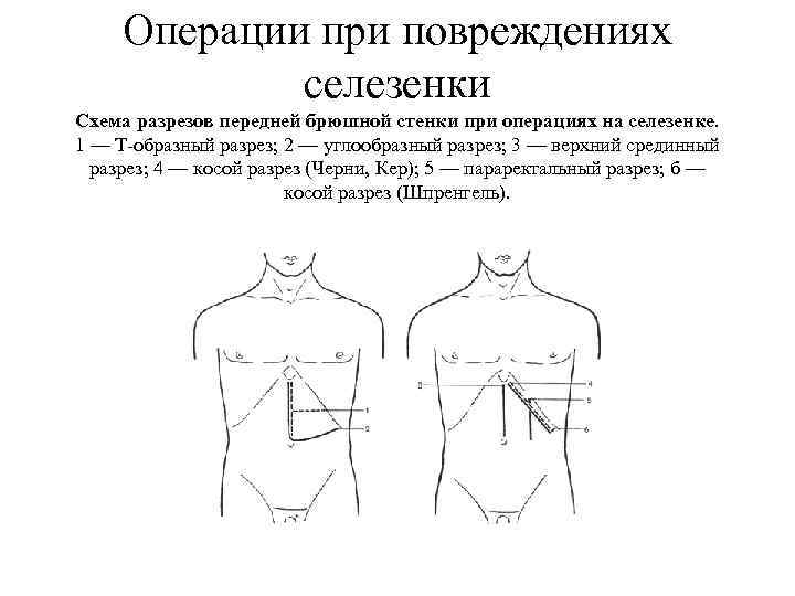 Операции на селезенке