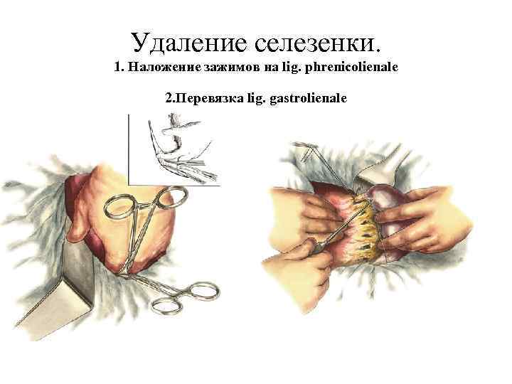 Удаление селезенки. 1. Наложение зажимов на lig. phrenicolienale 2. Перевязка lig. gastrolienale 