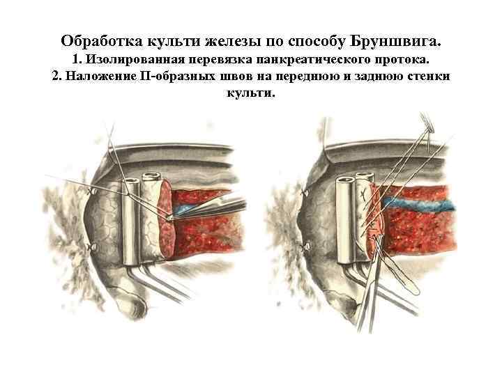 Обработка культи железы по способу Бруншвига. 1. Изолированная перевязка панкреатического протока. 2. Наложение П-образных