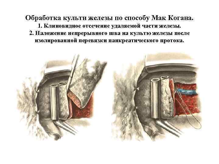 Обработка культи железы по способу Мак Когана. 1. Клиновидное отсечение удаляемой части железы. 2.