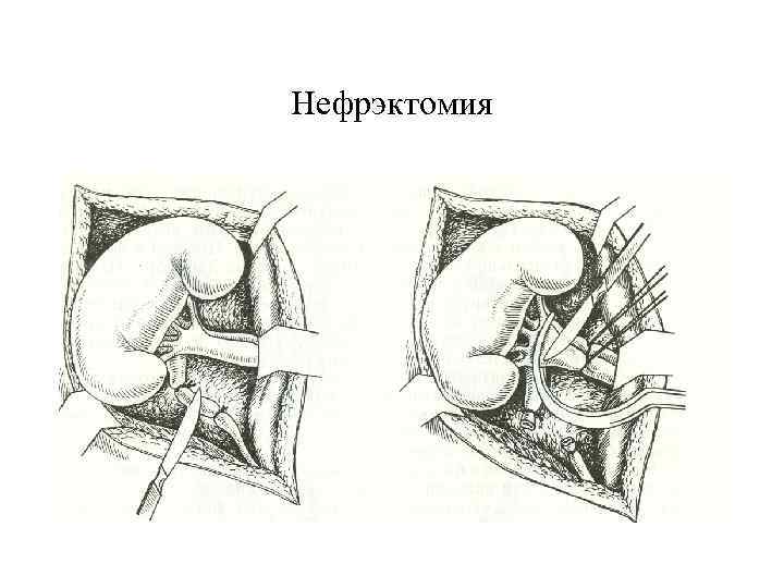 Нефрэктомия 