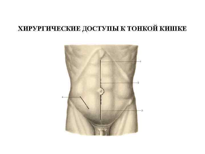 ХИРУРГИЧЕСКИЕ ДОСТУПЫ К ТОНКОЙ КИШКЕ 