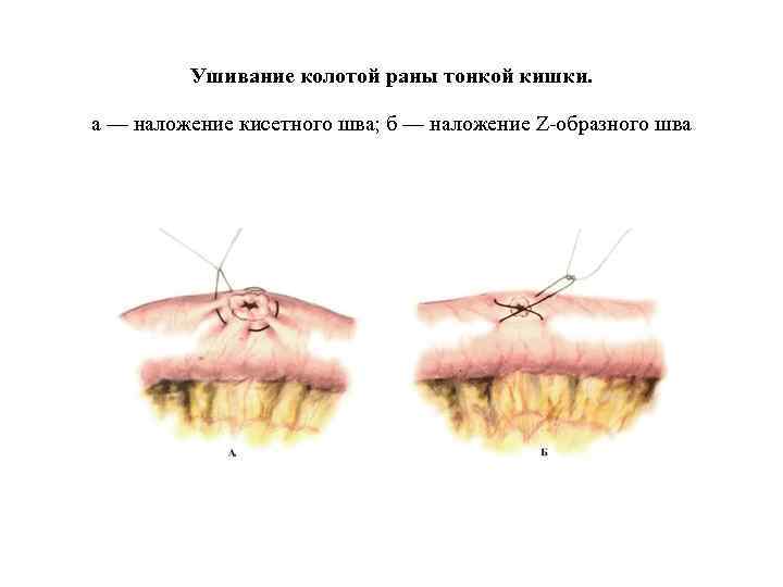 Открытые травмы живота картинки