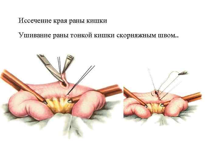 Иссечение края раны кишки Ушивание раны тонкой кишки скорняжным швом. . 