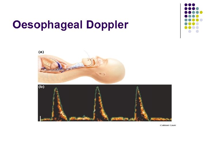 Oesophageal Doppler 