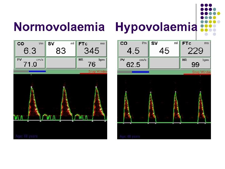 Normovolaemia Hypovolaemia 