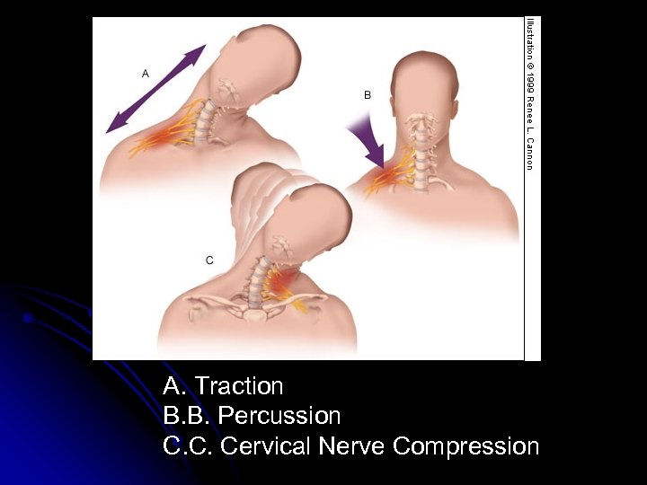 A. Traction B. B. Percussion C. C. Cervical Nerve Compression 