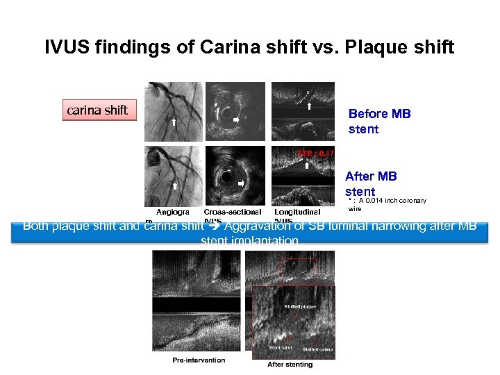 IVUS findings of Carina shift vs. Plaque shift * carina shift Before MB stent
