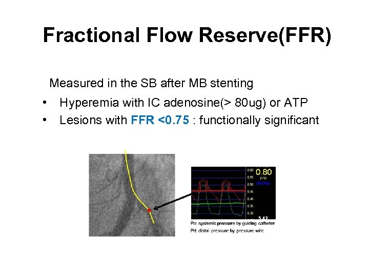 Fractional Flow Reserve(FFR) Measured in the SB after MB stenting • • Hyperemia with