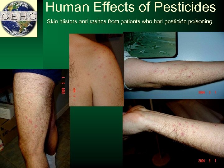 Human Effects of Pesticides Skin blisters and rashes from patients who had pesticide poisoning