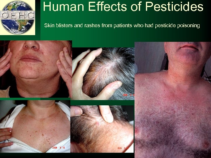 Human Effects of Pesticides Skin blisters and rashes from patients who had pesticide poisoning