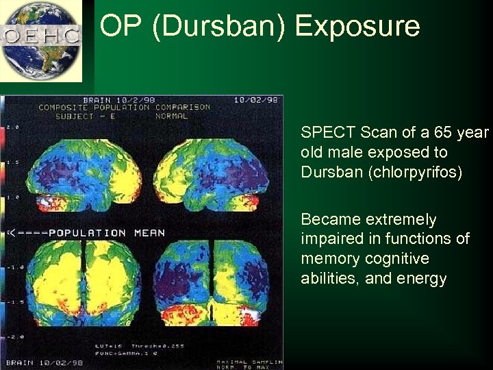 OP (Dursban) Exposure SPECT Scan of a 65 year old male exposed to Dursban