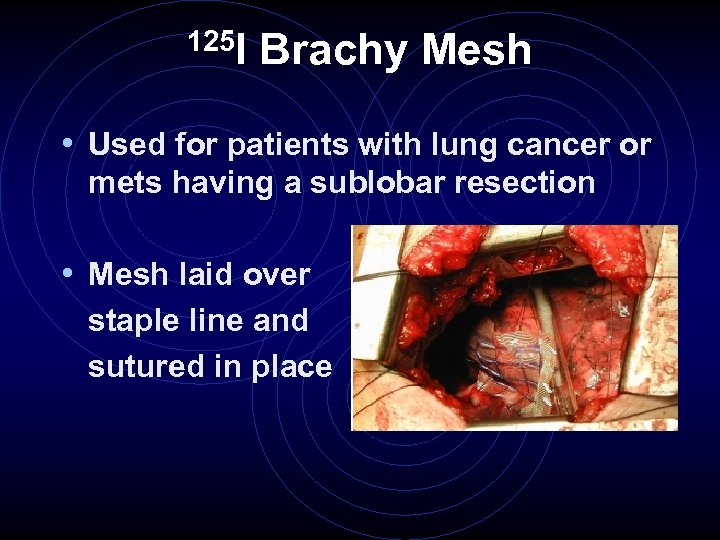 125 I Brachy Mesh • Used for patients with lung cancer or mets having