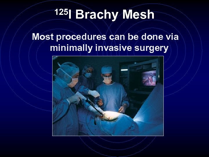 125 I Brachy Mesh Most procedures can be done via minimally invasive surgery 