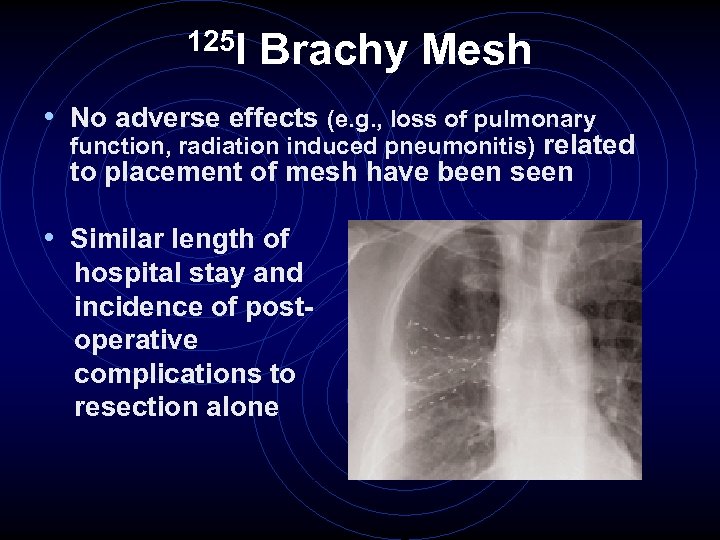 125 I Brachy Mesh • No adverse effects (e. g. , loss of pulmonary