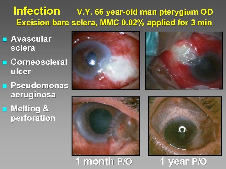 Infection V. Y. 66 year-old man pterygium OD Excision bare sclera, MMC 0. 02%