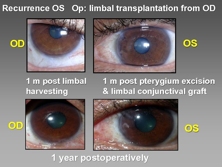 Recurrence OS Op: limbal transplantation from OD OS OD 1 m post limbal harvesting