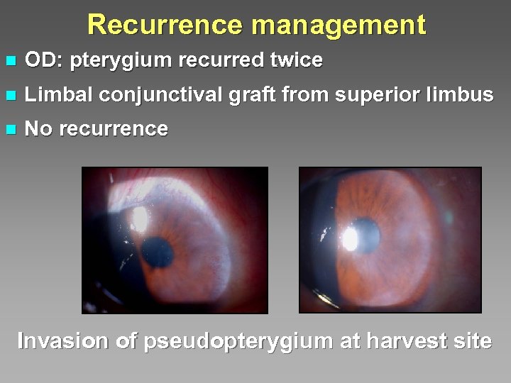 Recurrence management n OD: pterygium recurred twice n Limbal conjunctival graft from superior limbus