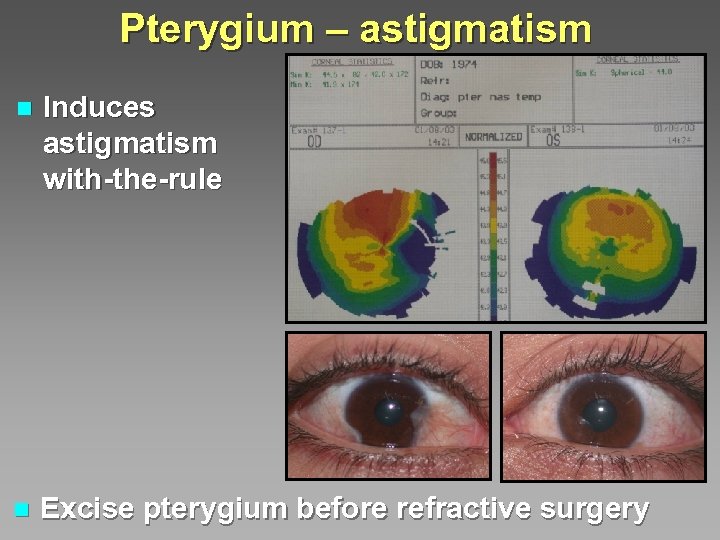 Pterygium – astigmatism n Induces astigmatism with-the-rule n Excise pterygium before refractive surgery 