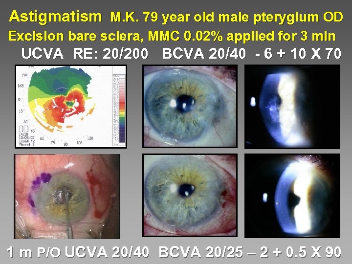 Astigmatism M. K. 79 year old male pterygium OD Excision bare sclera, MMC 0.