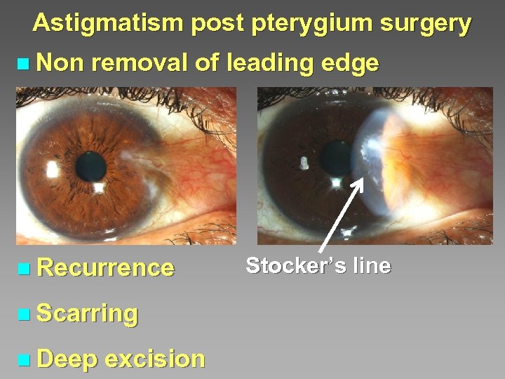 Astigmatism post pterygium surgery n Non removal of leading edge n Recurrence n Scarring