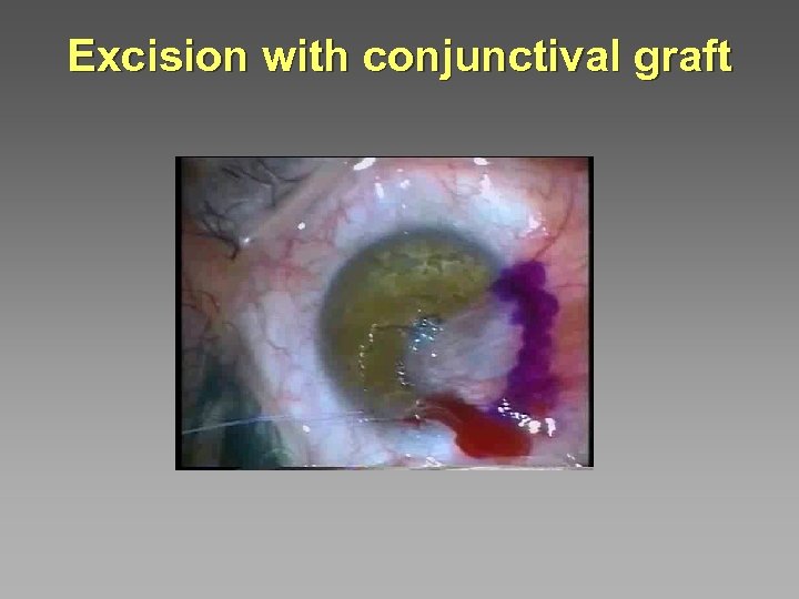 Excision with conjunctival graft 