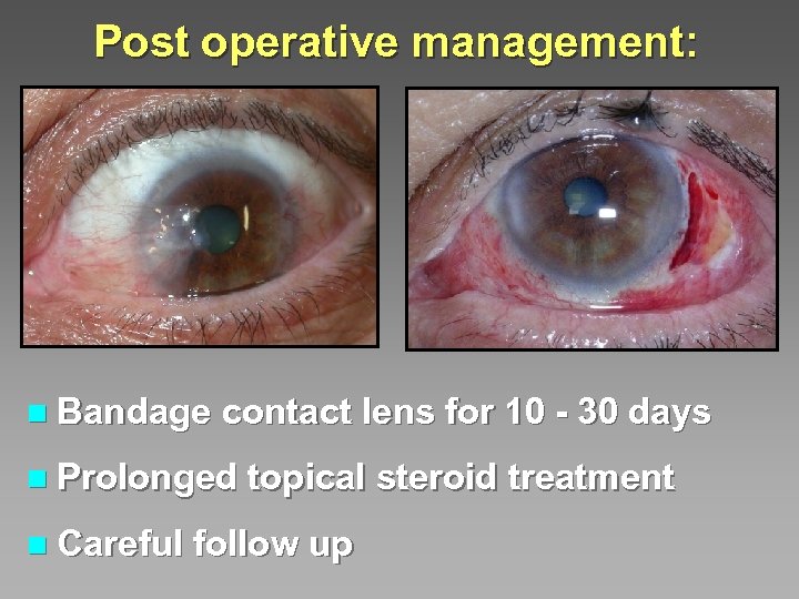 Post operative management: n Bandage contact lens for 10 - 30 days n Prolonged