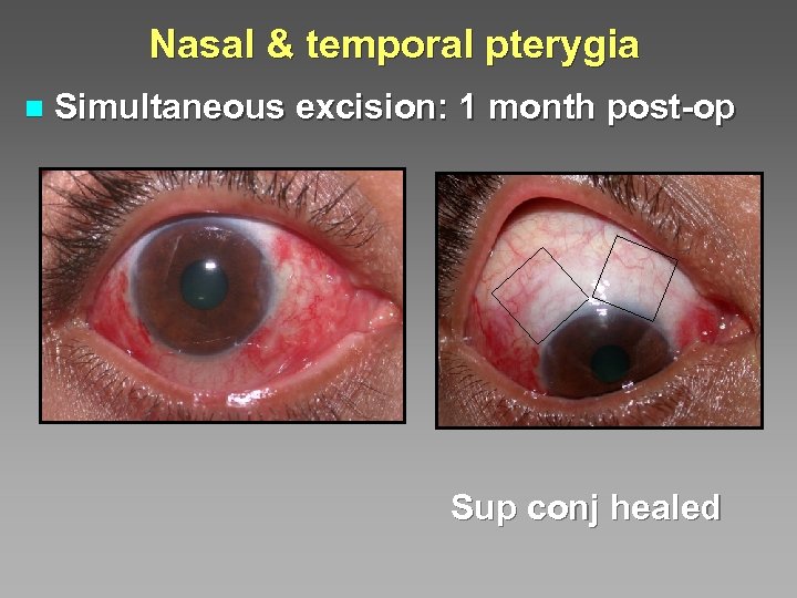 Nasal & temporal pterygia n Simultaneous excision: 1 month post-op Sup conj healed 