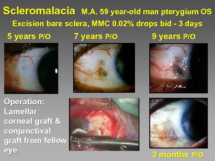 Scleromalacia M. A. 59 year-old man pterygium OS Excision bare sclera, MMC 0. 02%