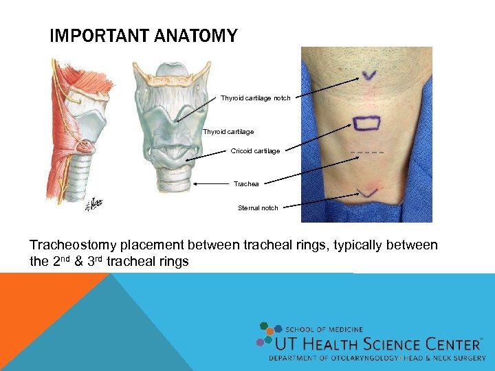 IMPORTANT ANATOMY Thyroid cartilage notch Thyroid cartilage Cricoid cartilage Trachea Sternal notch Tracheostomy placement