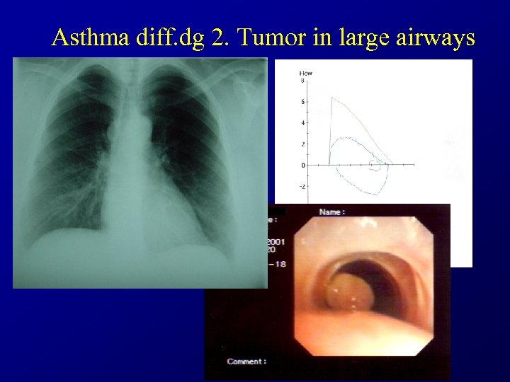 Asthma diff. dg 2. Tumor in large airways 