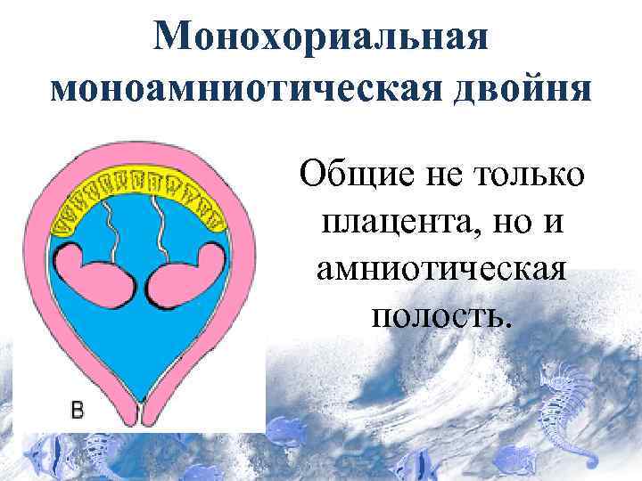 Монохориальная двойня. Монохориальная многоплодная беременность. Монохориальная моноамниотическая двойня. Монохориалтная монопмниатическая двойня. Монохромная ионоамниотическая Войня.