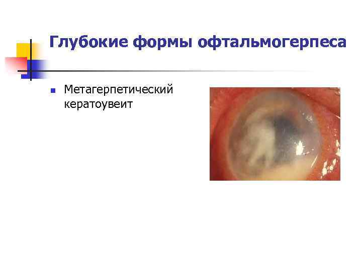 Глубокие формы офтальмогерпеса n Метагерпетический кератоувеит 