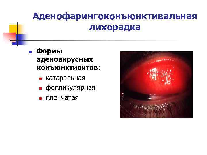 Аденофарингоконъюнктивальная лихорадка n Формы аденовирусных конъюнктивитов: n катаральная n фолликулярная n пленчатая 