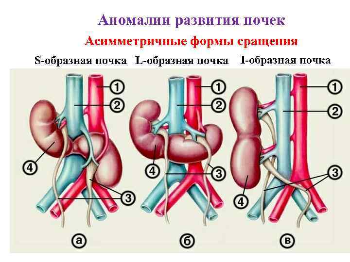 Аномалии развития почек Асимметричные формы сращения S-образная почка L-образная почка I-образная почка 