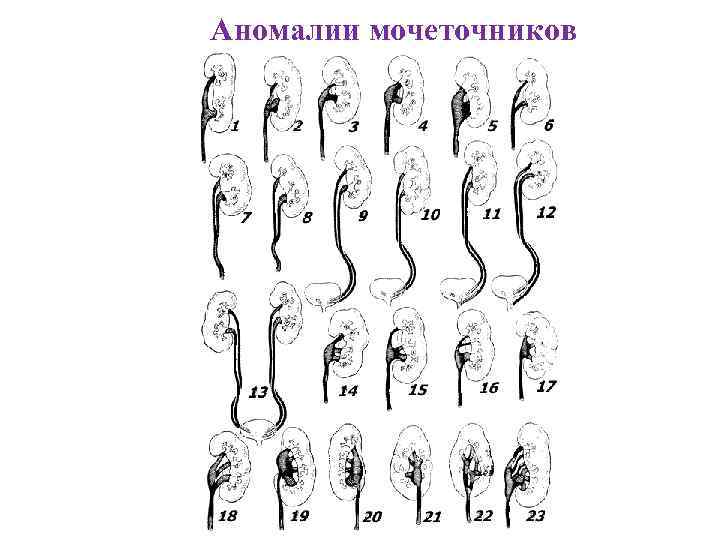 Аномалии мочеточников 