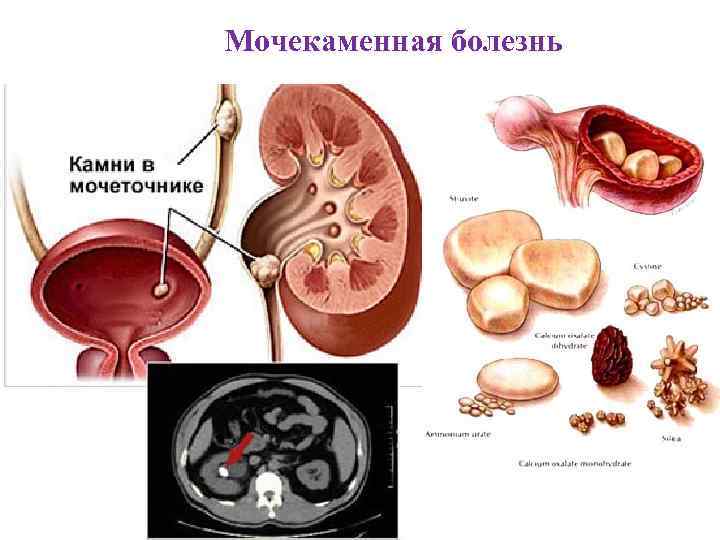 Мочекаменная болезнь 