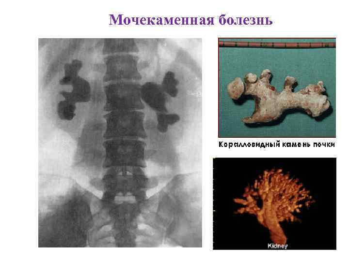 Мочекаменная болезнь 