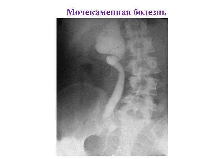 Мочекаменная болезнь 