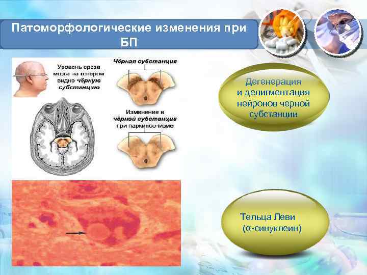 Патоморфологические изменения при БП Дегенерация и депигментация нейронов черной субстанции Тельца Леви (α-синуклеин) 