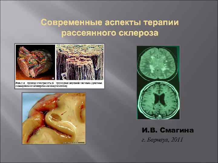 Современные аспекты терапии рассеянного склероза И. В. Смагина г. Барнаул, 2011 