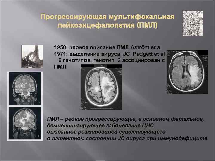 Прогрессирующая мультифокальная лейкоэнцефалопатия (ПМЛ) 1958: первое описание ПМЛ Aström et al 1971: выделение вируса