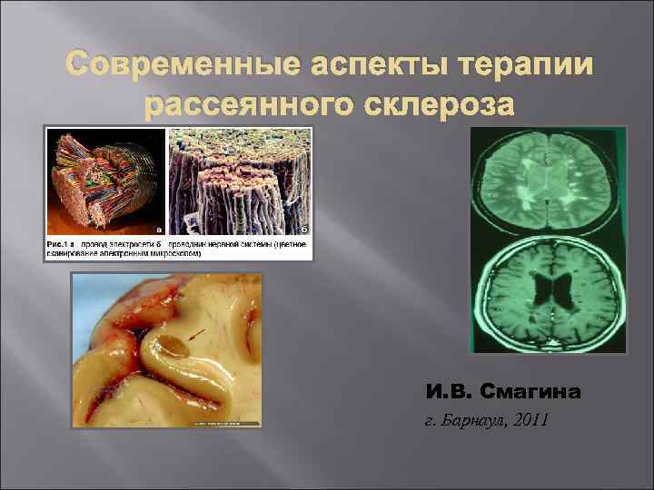 Современные аспекты терапии рассеянного склероза И. В. Смагина г. Барнаул, 2011 